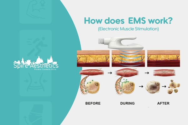 EMS treatment for post pregnancy weight loss treatment Amesbury