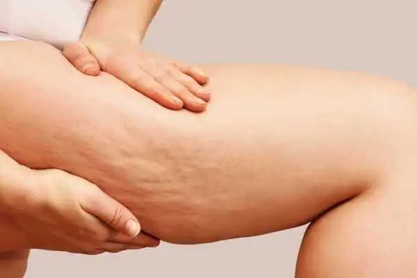 Image of woman showing leg with cellulite Amesbury