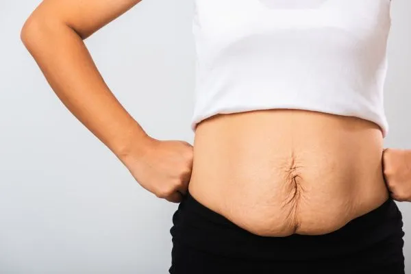 Image of a woman's stomach after weight loss with sagging skin following a gastric band Amesbury