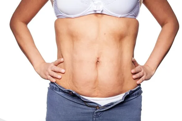 sagging skin on woman's stomach after weight loss injections Amesbury