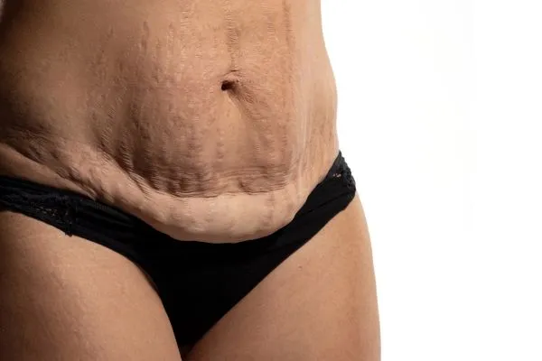 Image of womans stomach after weight loss injections Amesbury showing saggy skin