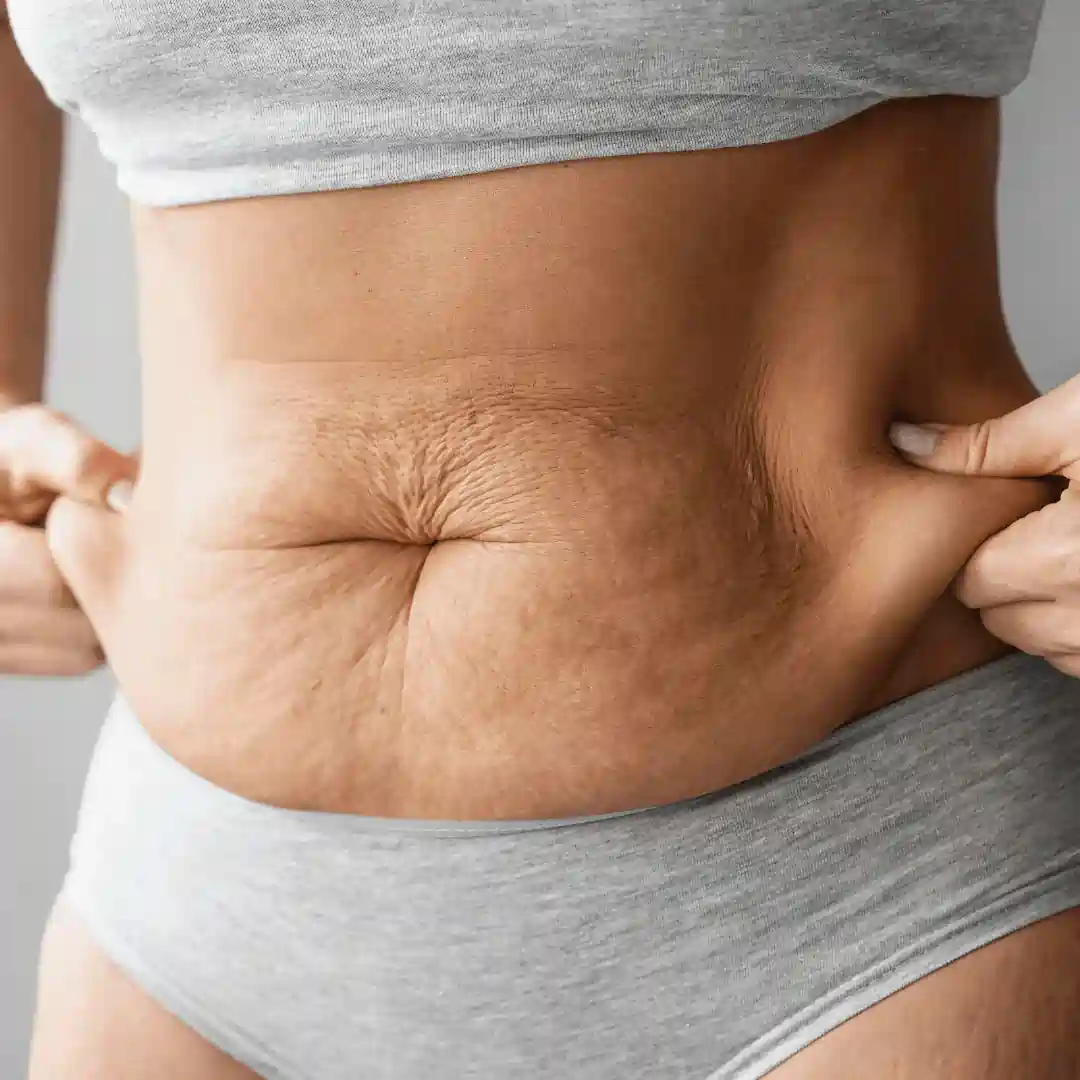 Is It Normal to Have Loose Skin After Pregnancy Amesbury?