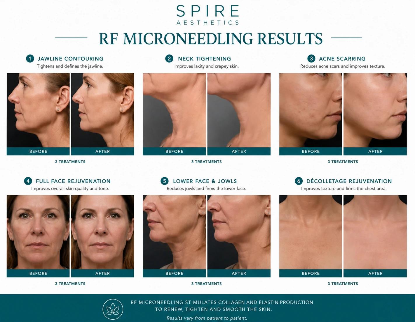 RF Microneedling Skin tightening Amesbury results