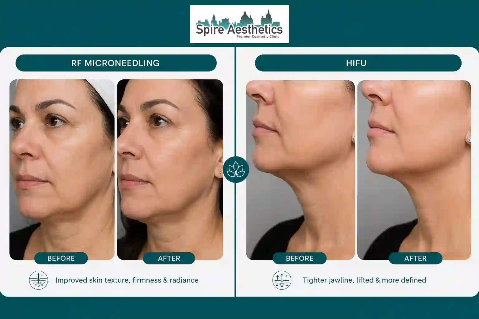 Can RF Microneedling and HIFU Be Combined Amesbury?
