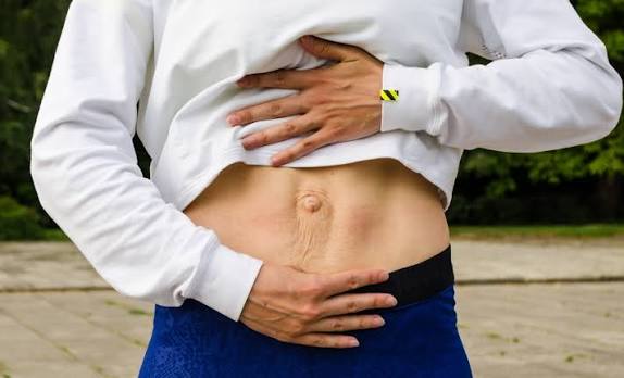 When Could Diastasis Recti Be the Missing Piece of the Puzzle Amesbury?