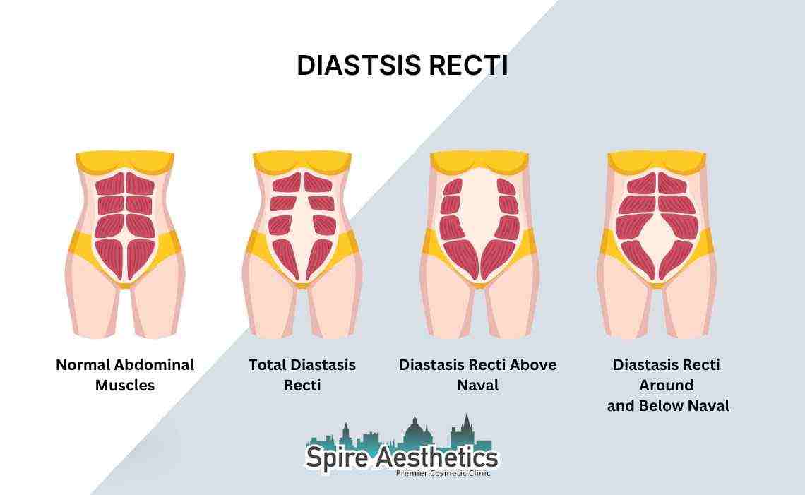 Is Non-Surgical Diastasis Recti Treatment Right for You? Common Concerns Answered Amesbury